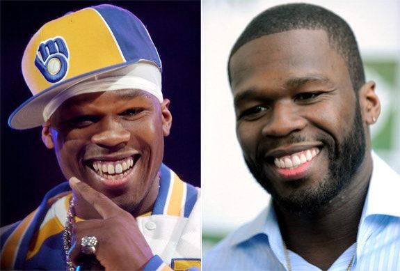Curtis ‘50 Cent’ Jackson before and after getting teeth fixed