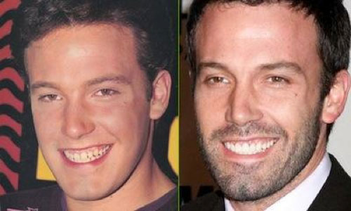 Ben Affleck before and after fixing teeth. 