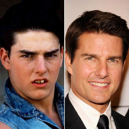 Tom Cruise fixed teeth.
