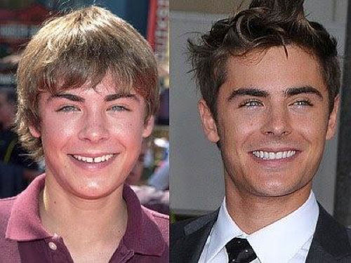 Zac Efron fixes teeth